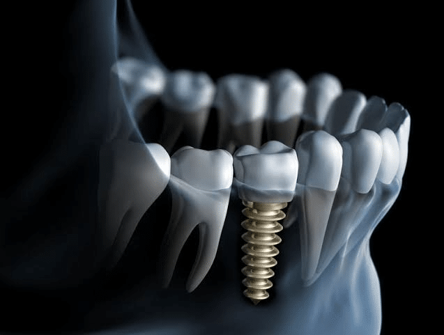 Dental İmplant Görseli