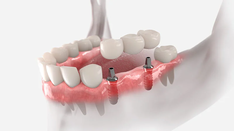 implant üstü portezler hakkında görsel metaryal